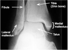 warwickshireanklefracture