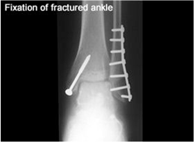 coventryanklefracturetreatment